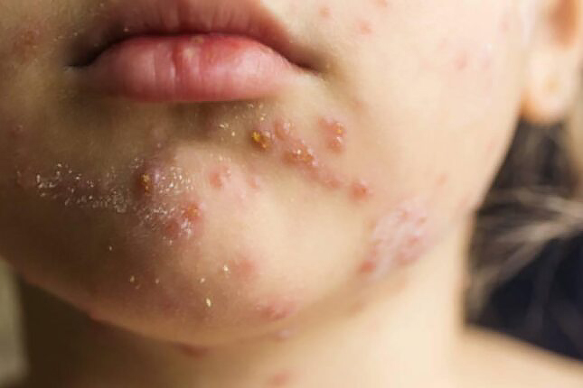 Bu epidemiya yenidən yayıldı, ölənlər var – XƏBƏRDARLIQ